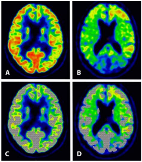 Diagnostics | Free Full-Text | FDG-PET versus Amyloid-PET Imaging for ...