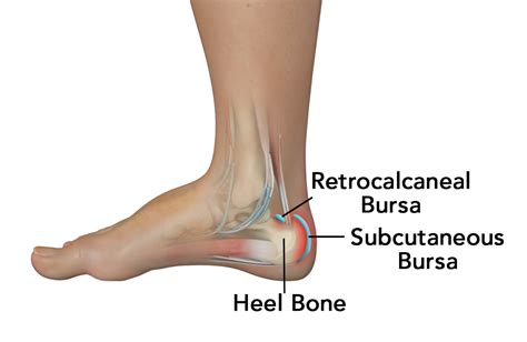 Achilles Tendon Bursitis Springfield | Retrocalcaneal Bursitis Chicopee, MA