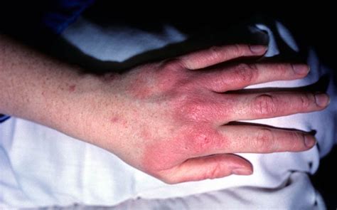 Contact Dermatitis Hands