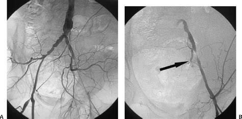 36 External Iliac Angioplasty and Stent Insertion | Radiology Key