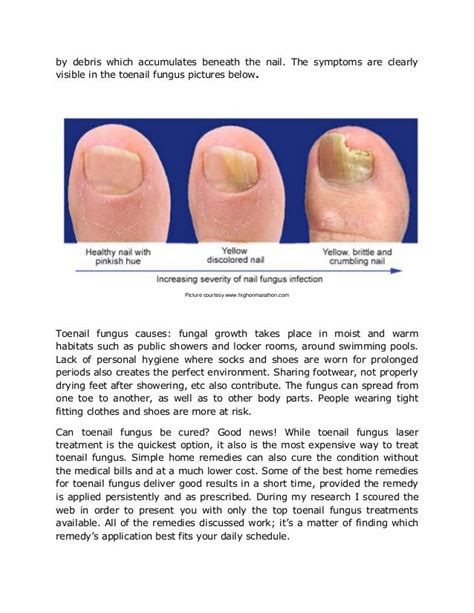 Toenail Fungus Vinegar Before And After / Nail Treatment Progression ...