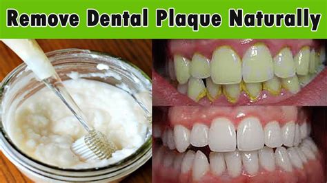 This Mouthwash Removes Plaque From Teeth In 2 Minutes - healhty and tips