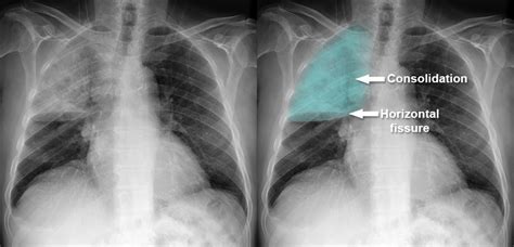 Lobar Pneumonia Xray