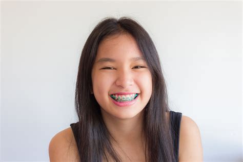 Why use Elastics (Rubber Bands) with Braces? | Orthodontist North York ...