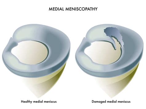 What is The Cause of Meniscus Tears? Expert Series – Howard J. Luks, MD