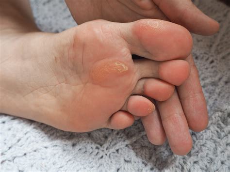 The calluses on the feet: how to reduce them with 7 natural remedies