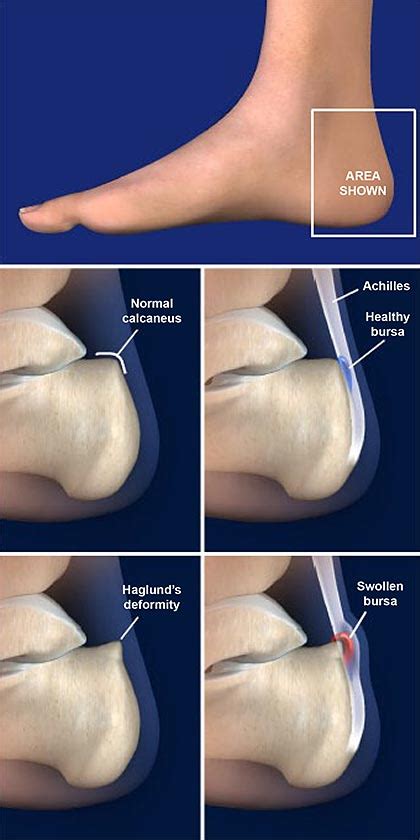 Haglund’s Deformity (Retrocalcaneal Bursitis) | Central Coast ...