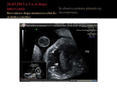 Hidrotorax fetal shunt pleuro amniotic