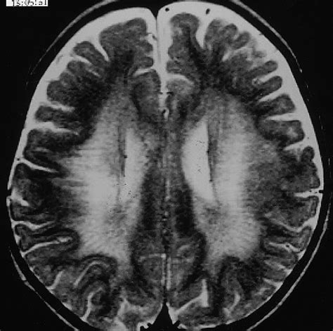 Leukodystrophy in Children: A Pictorial Review of MR Imaging Features ...