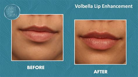 Vermilion Lip Lift | Sitelip.org