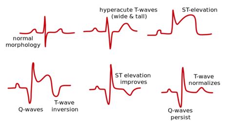 emDOCs.net – Emergency Medicine EducationECG Pointers: Post Myocardial ...