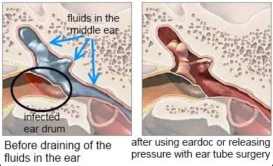 Middle Ear Fluid, Middle Ear Fluid Treatment, Kalyan, Thane, Mumbai, India