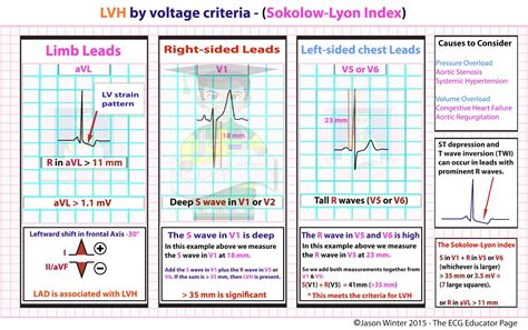 ECG Educator Blog : LVH by voltage criteria - (Sokolow-Lyon Index)