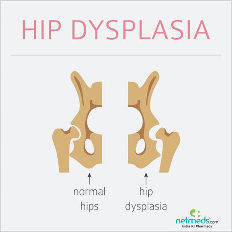 Hip Dysplasia: Causes, Symptoms And Treatment | Netmeds