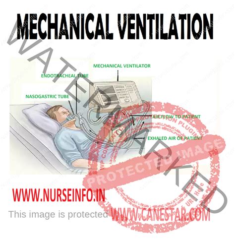 MECHANICAL VENTILATION - Nurse Info