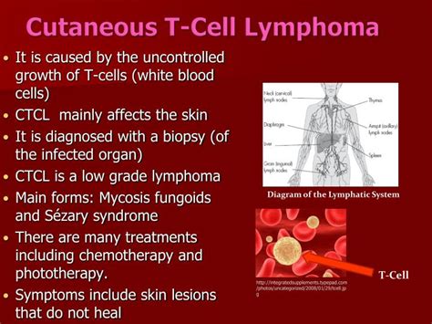 Cutaneous t cell lymphoma treatment