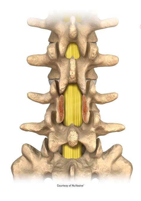 Lumbar Laminectomy, Fusion Instrumented Animation | lupon.gov.ph