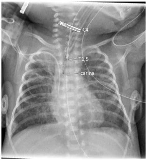 Endotracheal Tube Placement X Ray