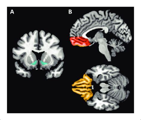 (A) Coronal view depicting the ventral striatum (in blue). (B) Sagittal ...