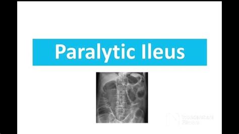 What is Paralytic Ileus & Causes | Methods for diagnosing Paralytic ...