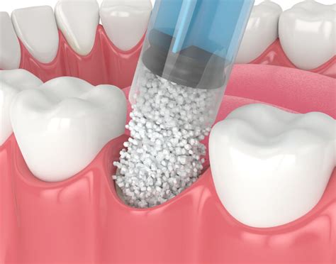 A Dentist in Parker, CO Explains: What is a Dental Bone Graft?