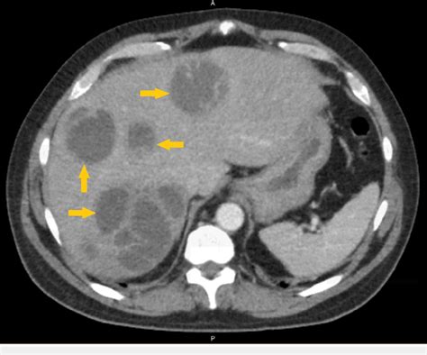 Initial CT scan of abdomen with arrows indicating multiple liver ...