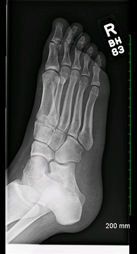 Normal Foot Xray Lateral