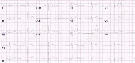 Second Degree AV Block Type I and 2:1 AV Block ECG | Learn the Heart