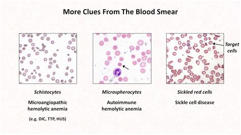 Why Do A Peripheral Blood Smear - Printable Form, Templates and Letter