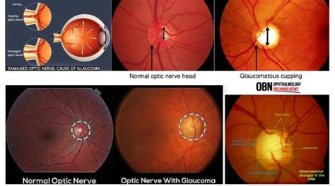 Glaucomatous Optic Nerve Damage | OBN