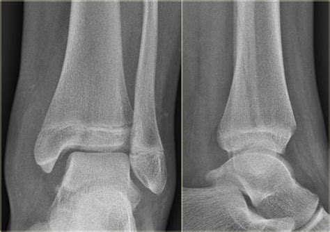 The Radiology Assistant : Ankle - Special fracture cases