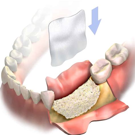 Bone Graft / Sinus Lift – Implant & Periodontal Institute of Torrance