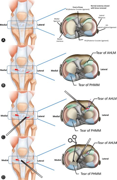 Efficacy of Arthroscopic Treatment for Concurrent Medial Meniscus ...