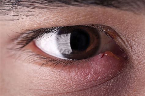 Bump on the Eyelid: Types, Symptoms, Causes, Treatment