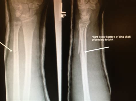 Ulna Hairline Fracture