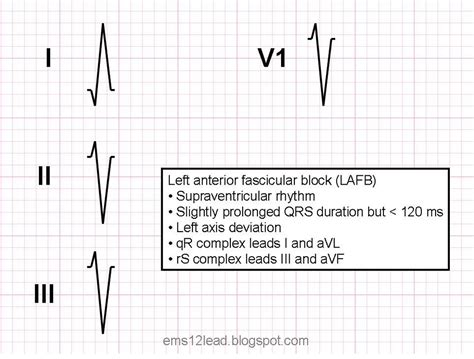 Left Anterior Fascicular Block (LAFB)