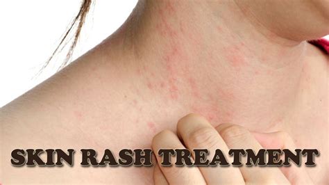 Skin Rash Treatment - How to Treat Itchy Skin Rash Naturally - YouTube