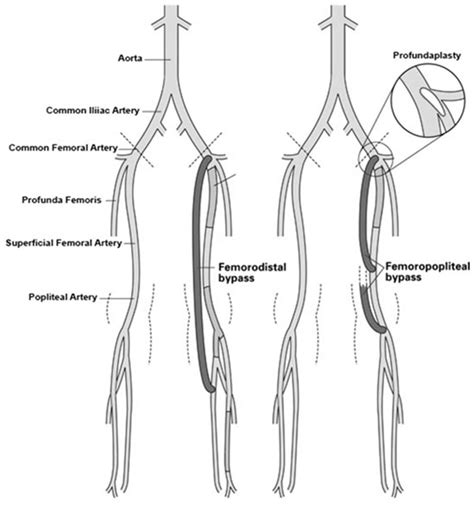 Springfield Heart Surgeons LLC - Femoral Bypass Surgery