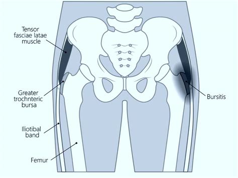 Hip Bursitis Anatomy