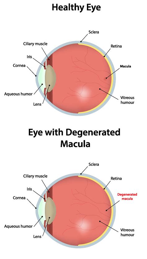 Macular Degeneration | Capitol Eye Care | Jefferson City, MO