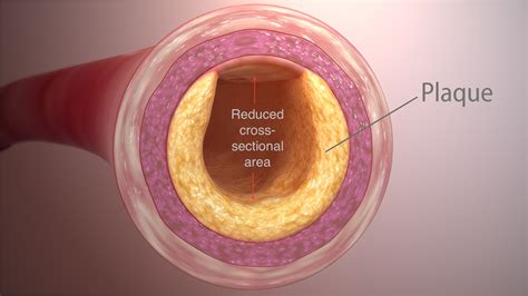 Cross Section Of An Artery