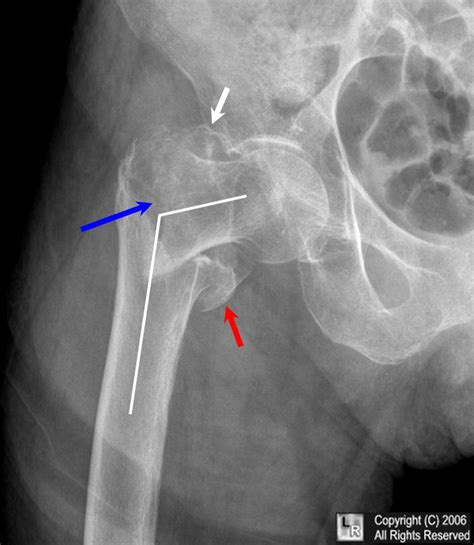 Femoral neck vs intertrochanteric fracture - yahooDer