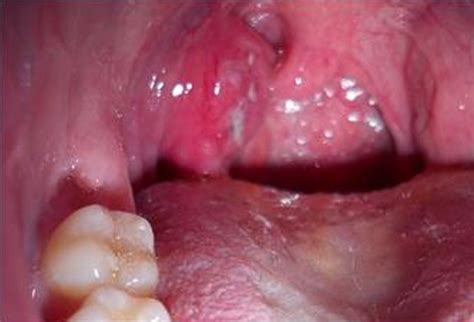 Strep Throat - Pictures, Symptoms, Treatment, Contagious, Incubation Period