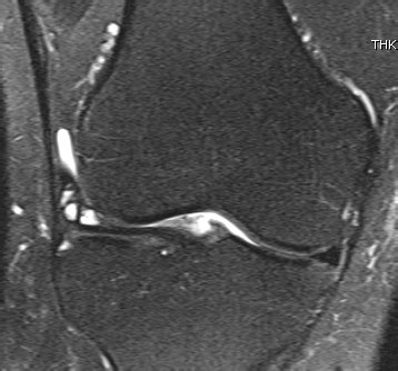 Meniscal Cysts | The Bone School