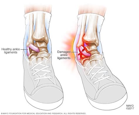 Sprained ankle - Symptoms and causes - Mayo Clinic