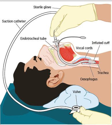 Tracheostomy Tube Suctioning