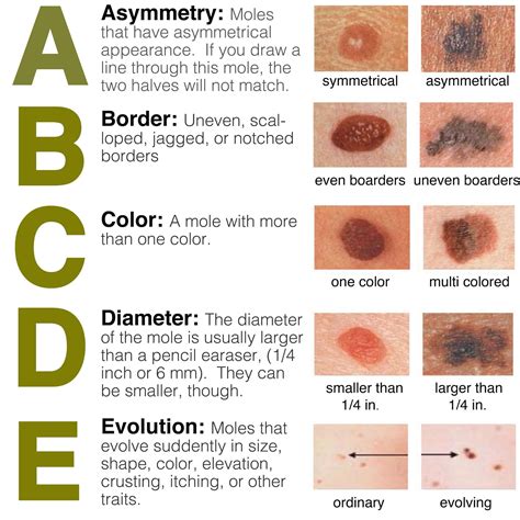 Abcde Rule Of Skin Cancer Detection