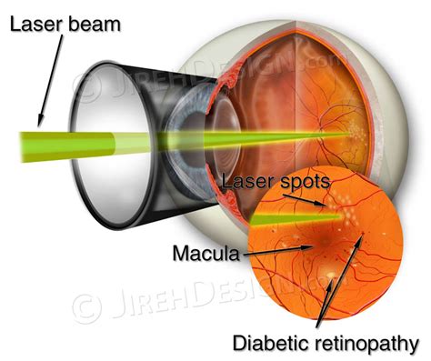 Retinal laser for diabetic retinopathy - #SUVR0003 - Stock eye images