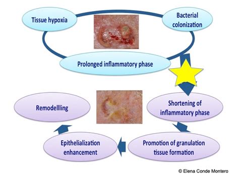 Brief overview of wound healing - Elena Conde Montero