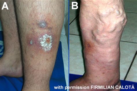 Pathogenesis of the venous ulcer – JOSEF PFLUG VASCULAR LABORATORY